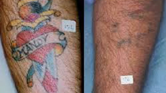 Tattoo Removal – Now It’s Getting Easier Once You Get Your Tattoo Ink