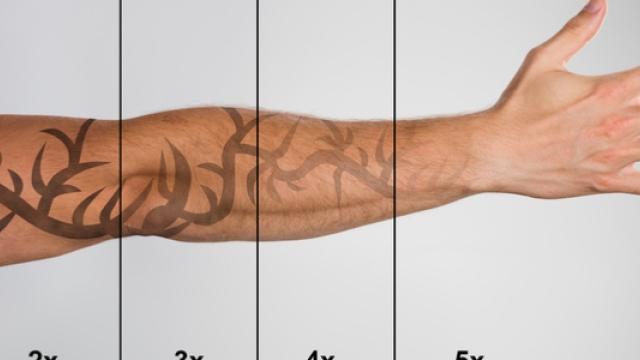 Laser Tattoo Removal – Frequently Asked Questions