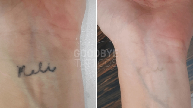 Tattoo Ink Removal And Ink Removing Creams – Do Your Research