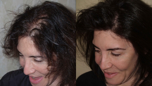 Unlocking Confidence: The Ultimate Guide to Hair Implants
