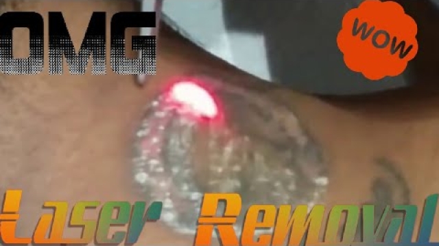 The Benefits Of Laser Tattoo Removal